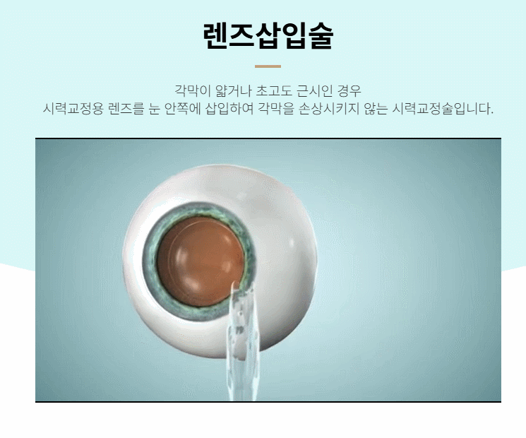 각막 절삭 방식의 라식과 렌즈 삽입 방식의 ICL 수술 차이점 비교도